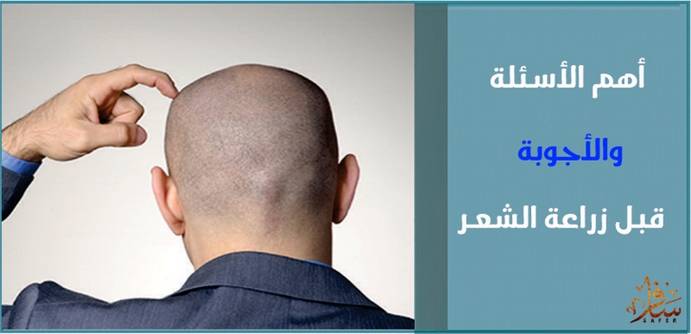 أهم الأسئلة والأجوبة قبل زراعة الشعر