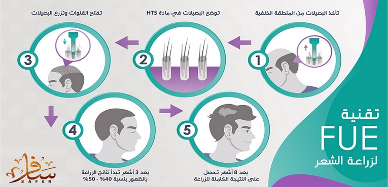ما هي تقنية الاقتطاف FUE لزراعة الشعر في تركيا